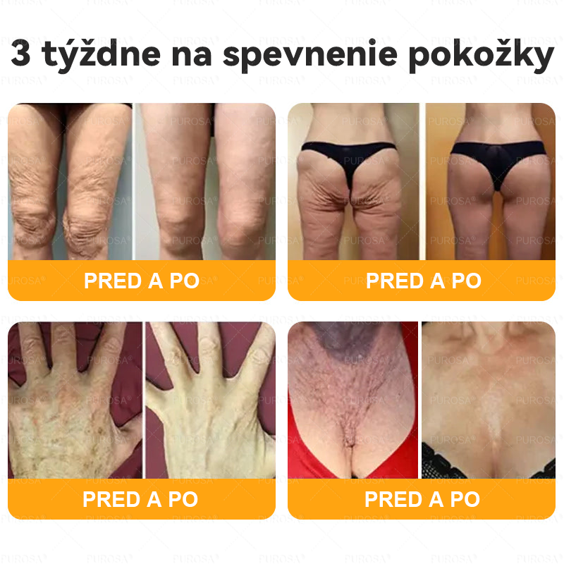 🐝PUROSA® včelí jed Krém na obnovu pokožky🔥🔥 POSLEDNÝ DEŇ 80% ZĽAVA