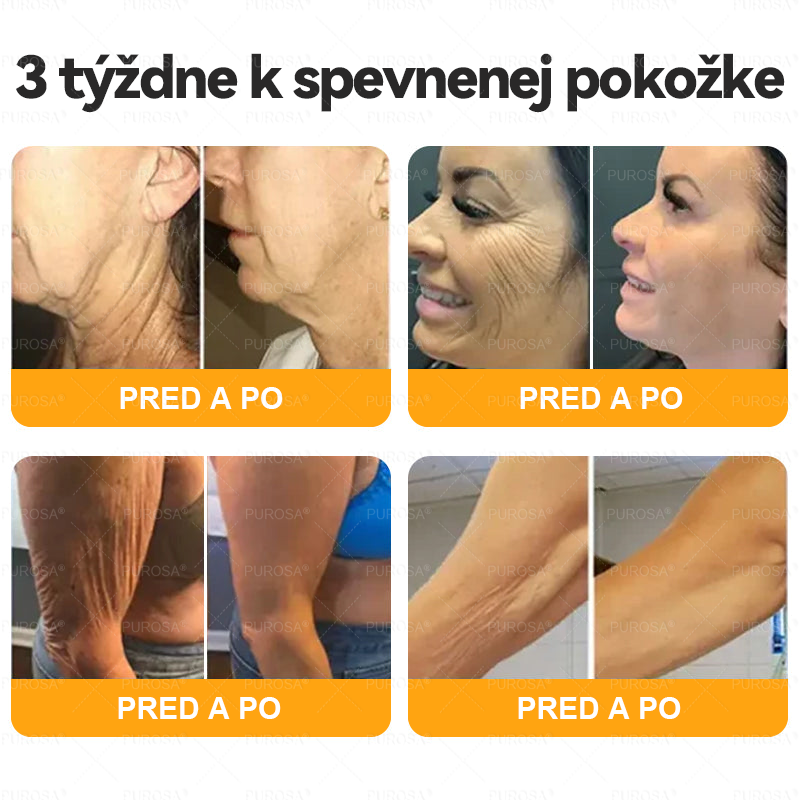 🐝PUROSA® včelí jed Krém na obnovu pokožky🔥🔥 POSLEDNÝ DEŇ 80% ZĽAVA